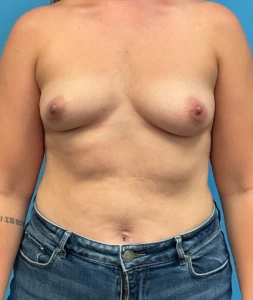 Before Breast Augmentation (Front)