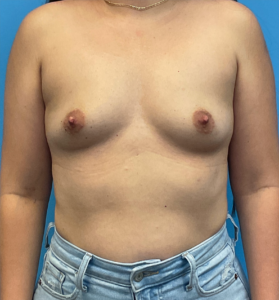 Breast-Augmentation-Case--25743 | Before Breast Augmentation 1