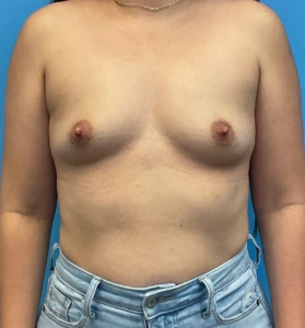 Breast-Augmentation-Case--25743 | Before Breast Augmentation 1