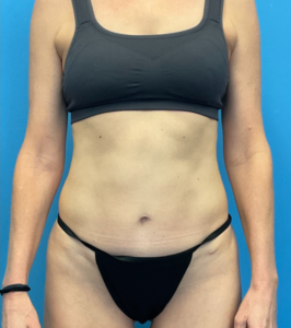 Revision-Tummy-Tuck-Case--23643 | Before Tummy Tuck 1