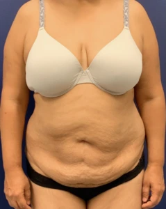 Liposuction-Abdominoplasty-Case--25576 | Before Body 1