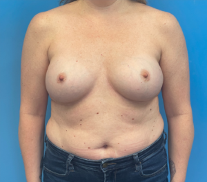 Breast-Reconstruction-Case--27065 | Before Dr. Samir Rao 1