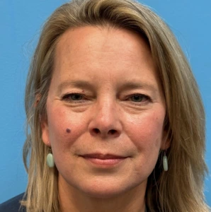 Blepharoplasty-Case--13622 | Before Face 1