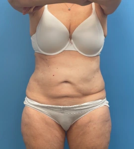 Abdominoplasty-Case--23690 | Before Body 1