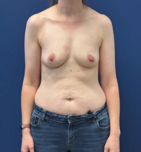 Breast-Augmentation-Case--28670 | Before Breast Augmentation 1