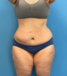 Tummy-Tuck-Case--28426 | Before Body 1