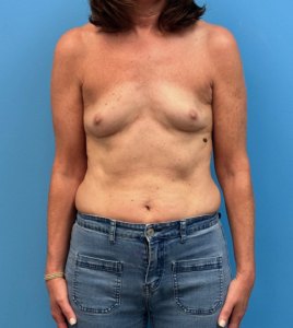 Breast-Reconstruction-Case--28688 | Before Dr. Samir Rao 1