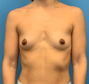 Breast-Augmentation-Case--24407 | Before Breast Augmentation 1