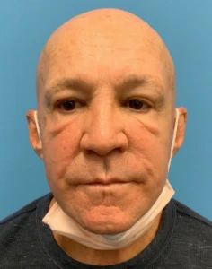 Blepharoplasty-Case--24169 | Before Face 2