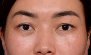 Blepharoplasty-Case--356 | Before Face 1