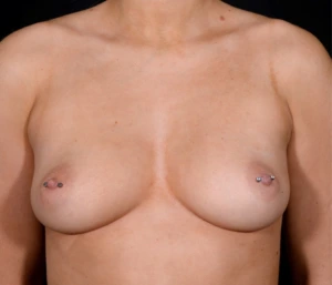 Breast-Augmentation-Case--350 | Before Breast Augmentation 1
