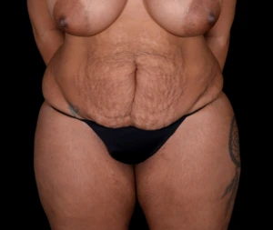 Liposuction-Tummy-Tuck-Case--338 | Before Body 1