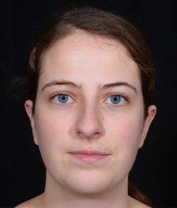 Rhinoplasty-and-Chin-Implant-Case--381 | Before Face 1