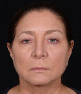 Quad-Blepharoplasty-Case--358 | Before Eyelid Surgery 1