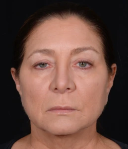 Quad-Blepharoplasty-Case--358 | Before Face 1