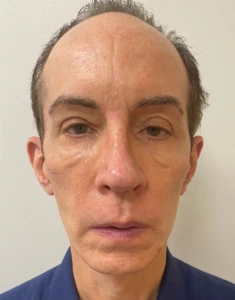 Quad-Blepharoplasty-Case--357 | Before Face 1