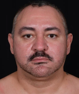 Liposuction-Case--368 | Before Face 1