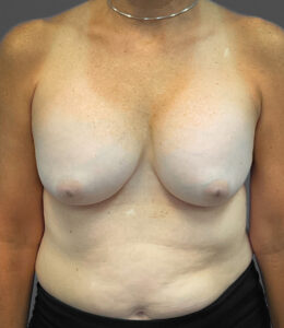 Augmentation-Mastopexy-Case--1213 | Before Breast Augmentation With Lift 1