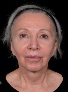 Facelift-Case--365 | Before Face 1