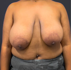 Breast-Reduction-Case--5320 | Before Breast Reduction 1