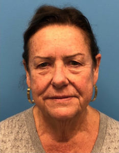 Facelift-Case--14406 | Before Neck Lift 1