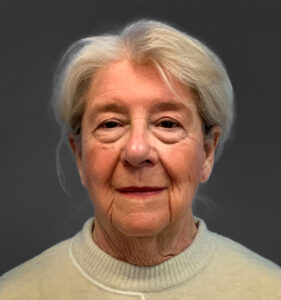 Blepharoplasty-Case--3336 | Before Eyelid Surgery 2