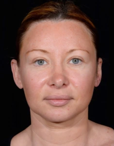 Facelift-Case--355 | Before Face 1