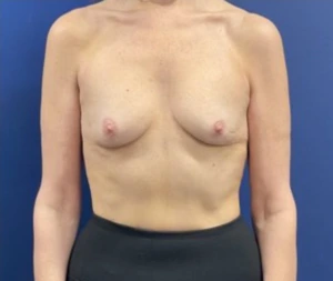 Subfascial-Breast-Augmentation-Case--26649 | Before Dr. Samir Rao 1