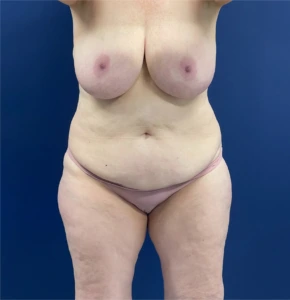 Mommy-Makeover-Case--26853 | Before Body 1