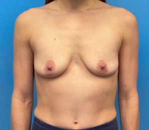 Breast-Augmentation-Mastopexy-Case--25025 | Before Dr. Samir Rao 1