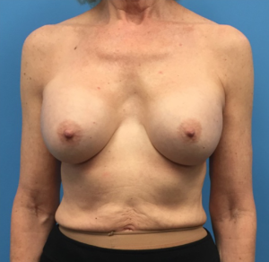 Revision-Breast-Augmentation-Case--237 | Before Dr. Samir Rao 1