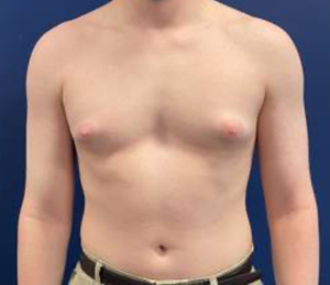 Gynecomastia-Case--214 | Before Gynecomastia / Male Breast Reduction 1