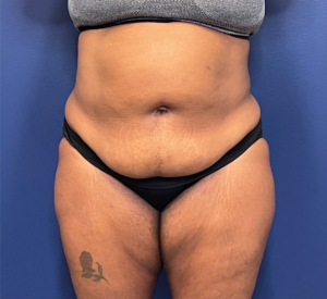 Lipoabdominoplasty-Case--245 | Before Liposuction 1