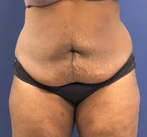 Case--257 | Before Body 1