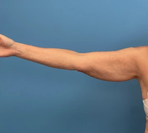 Liposuction-Case--23690-2 | Before Body 2