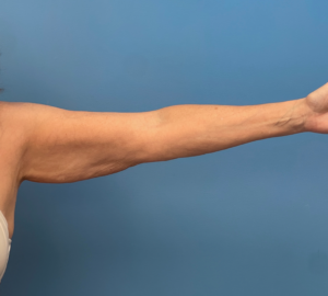 Liposuction-Case--23690-2 | Before Liposuction 1