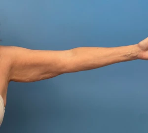 Liposuction-Case--23690-2 | Before Body 1