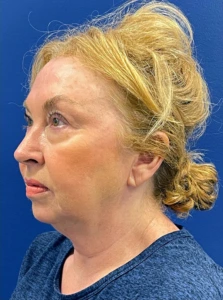 Facelift-Case--22860 | Before Face 2