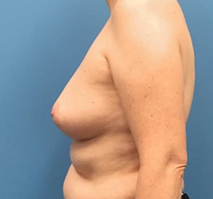 Case--135 | Before Breast Reconstruction 2