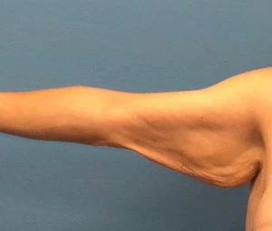 Brachioplasty-Arm-Lift-Case--18182 | Before Body 1
