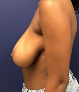 Breast-Reduction-Case--27254 | Before Breast Reduction 2