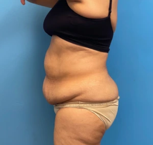 Lipoabdominoplasty-Case--27602 | Before Body 2