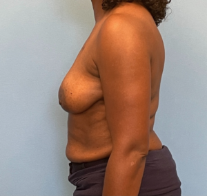 Breast-Reconstruction-Case--23930 | Before Dr. Samir Rao 2