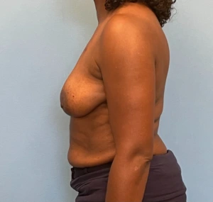 Breast-Reconstruction-Case--23930 | Before Breast Reconstruction 2