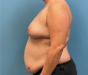 DIEP-Flap-Case--28021 | Before DIEP Flap 2