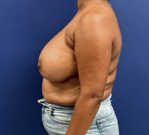 Breast-Reduction-Case--28242 | Before Dr. Samir Rao 2