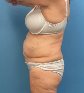 Abdominoplasty-Case--23690 | Before Dr. Samir Rao 2