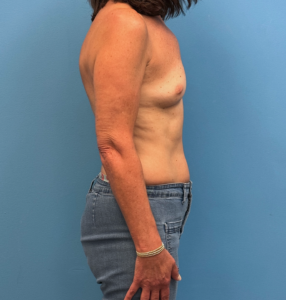 Breast-Reconstruction-Case--28688 | Before Dr. Samir Rao 2