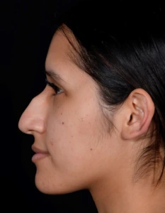 Rhinoplasty-Case--376 | Before Face 2