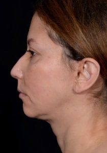Rhinoplasty-Case--375 | Before Face 1